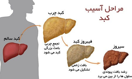 کبد چرب؛ از علائم تا رژیم غذایی