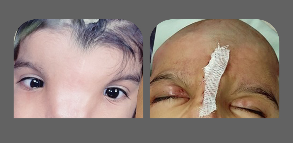 درمان ناهنجاری چهره و جمجمه دختر ۴ ساله