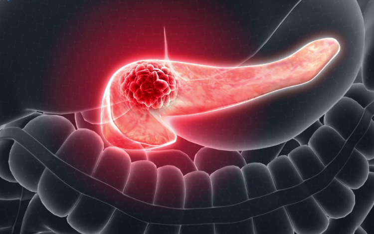 سرطان پانکراس؛ بیماری خاموش