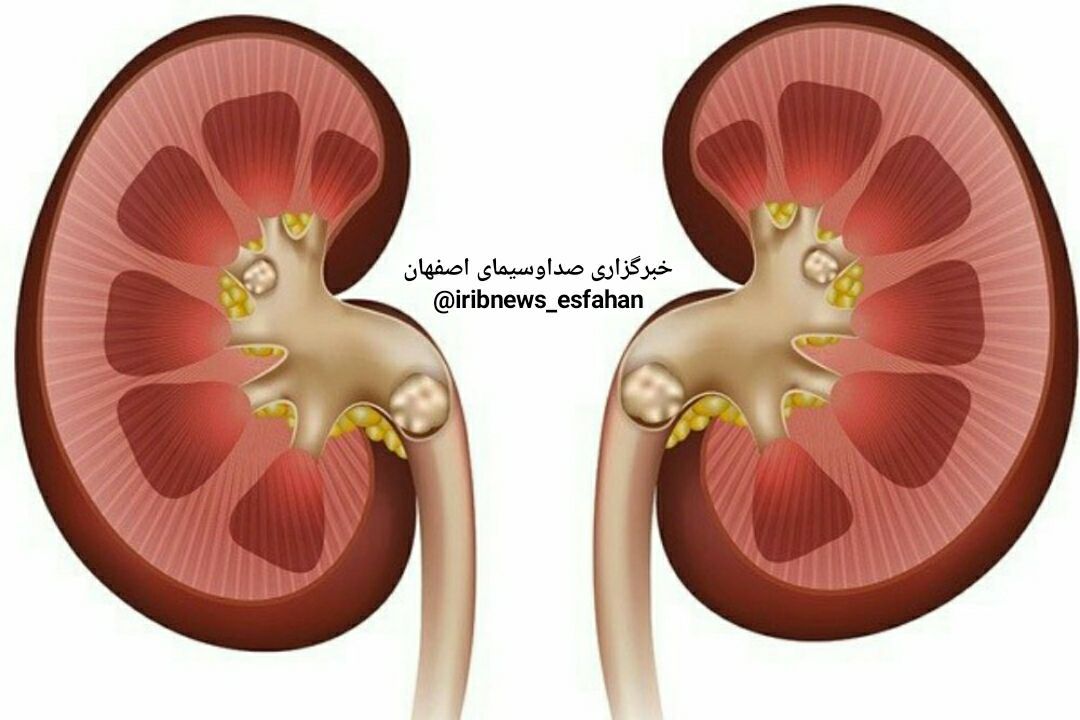 عوامل موثر در افزایش خطر تشکیل سنگ کلیه