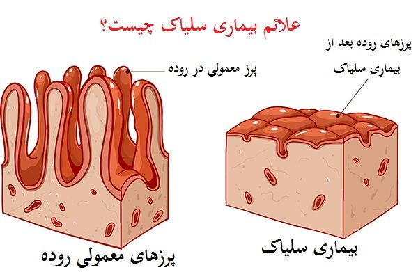 شناسایی حدود ۱۰۸بیمار سلیاکی در کهگیلویه وبویراحمد