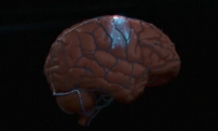 موفقیت سنگرون در کاشت دستگاه ثبت داده های مغزی برای معلولان