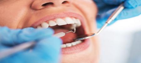 رعایت نکردن بهداشت دهان و دندان؛ مهمترین عامل بیماری لثه