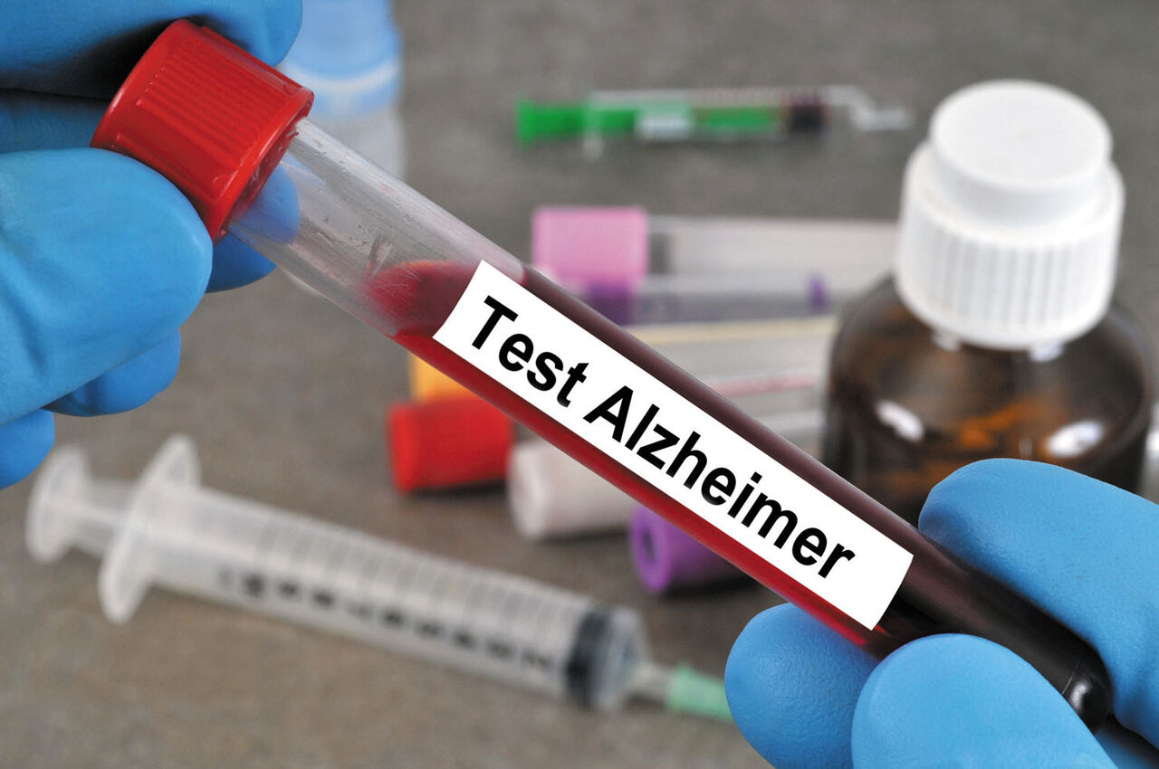 روشی جدید برای تشخیص بیماری آلزایمر  از طریق خون