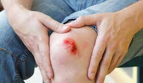 راه‌های جلوگیری از عفونت زخم‌ها