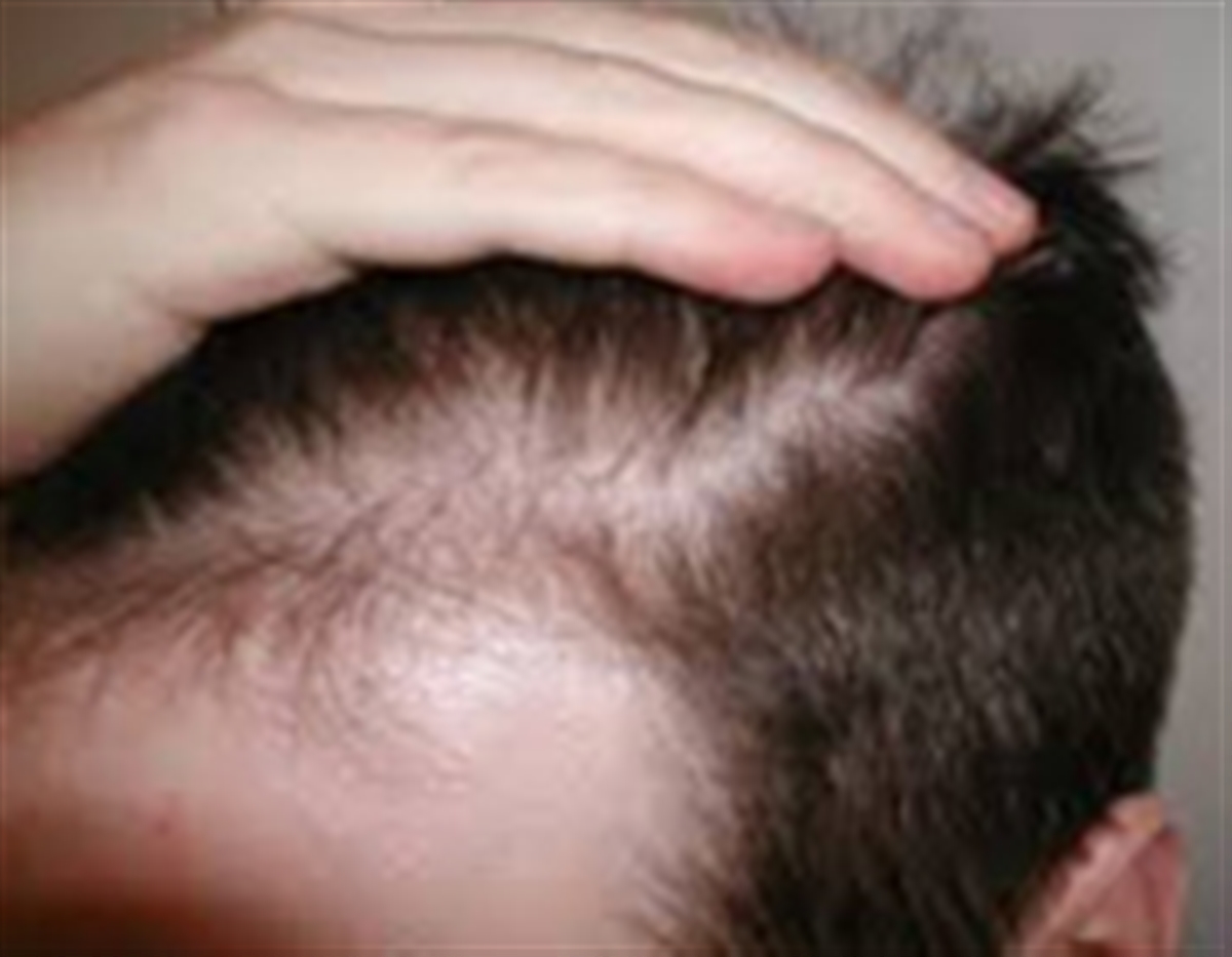 اثرات استرس و بیماری ها بر ریزش مو