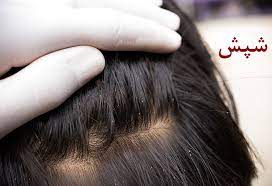 بیش از ۲۰۶ هزار نوجوان  خوزستانی مورد ارزیابی پوست و مو قرار گرفتند