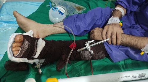 عمل موفق جراحی پیوند پای قطع شده در مشهد
