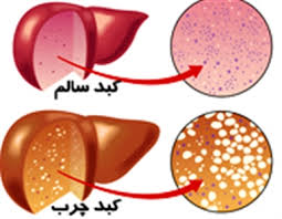 بهترین روش برای در امان ماندن از کبد چرب