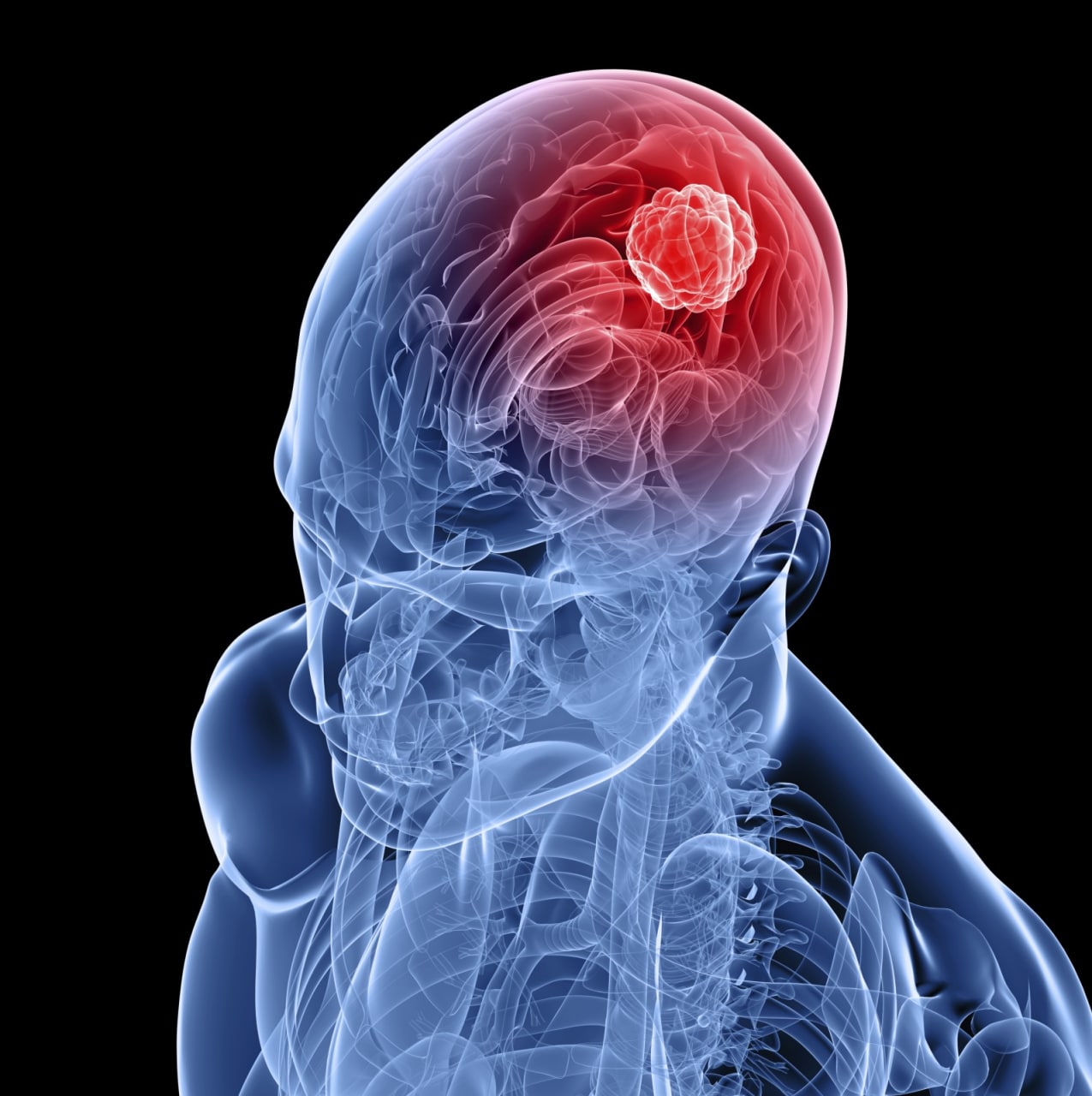 خستگی مفرط شاید ناشی از تومور‌های سرطان مغز باشد