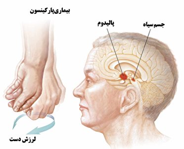 ماه آوریل، ماه آگاهی از بیماری پارکینسون