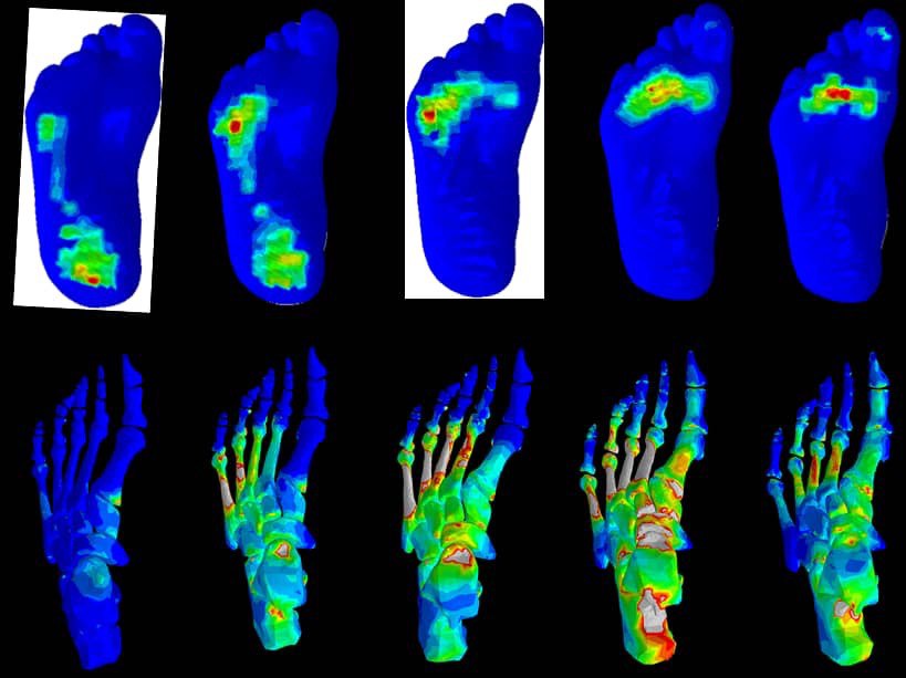 بررسی انگشتان پای دیابتی‌ها برای طراحی اصولی کفی طبی