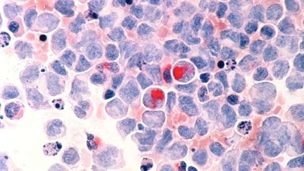 هدف قرار گرفتن سلول‌های عامل عود سرطان خون برای درمان با سلول‌های CAR T