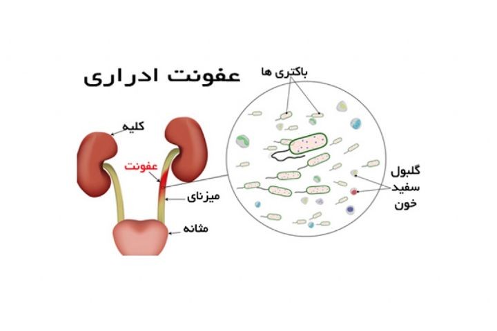 راه های خانگی رفع عفونت های ادراری