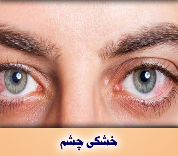 بررسی اثربخشی درمان خشکی چشم با استفاده از پالس نوری شدید در دانشگاه علوم پزشکی مشهد