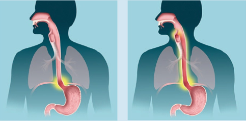 رفلاکس پنهان: مراقب رفلاکس بدون علامت معده باشید
