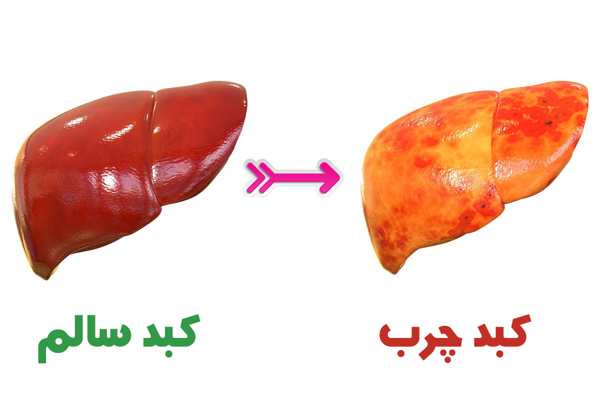 مهم‌ترین علل پیدایش کبد چرب