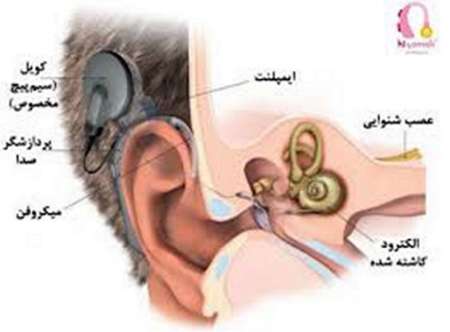 ۸۸ عمل پروتز کاشت حلزون برای افراد کم شنوا در خراسان رضوی