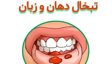 رژیم غذایی در بیماری تبخال