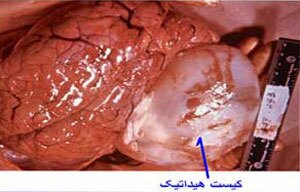 ابتلای چهار کهگیلویه و بویراحمدی به بیماری خطرناک کیست هیداتید