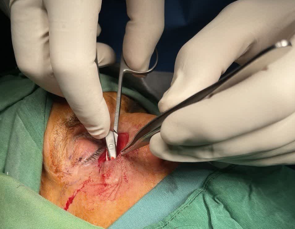 انجام عمل جراحی تومور پلک تحتانی برای اولین باردر گناباد