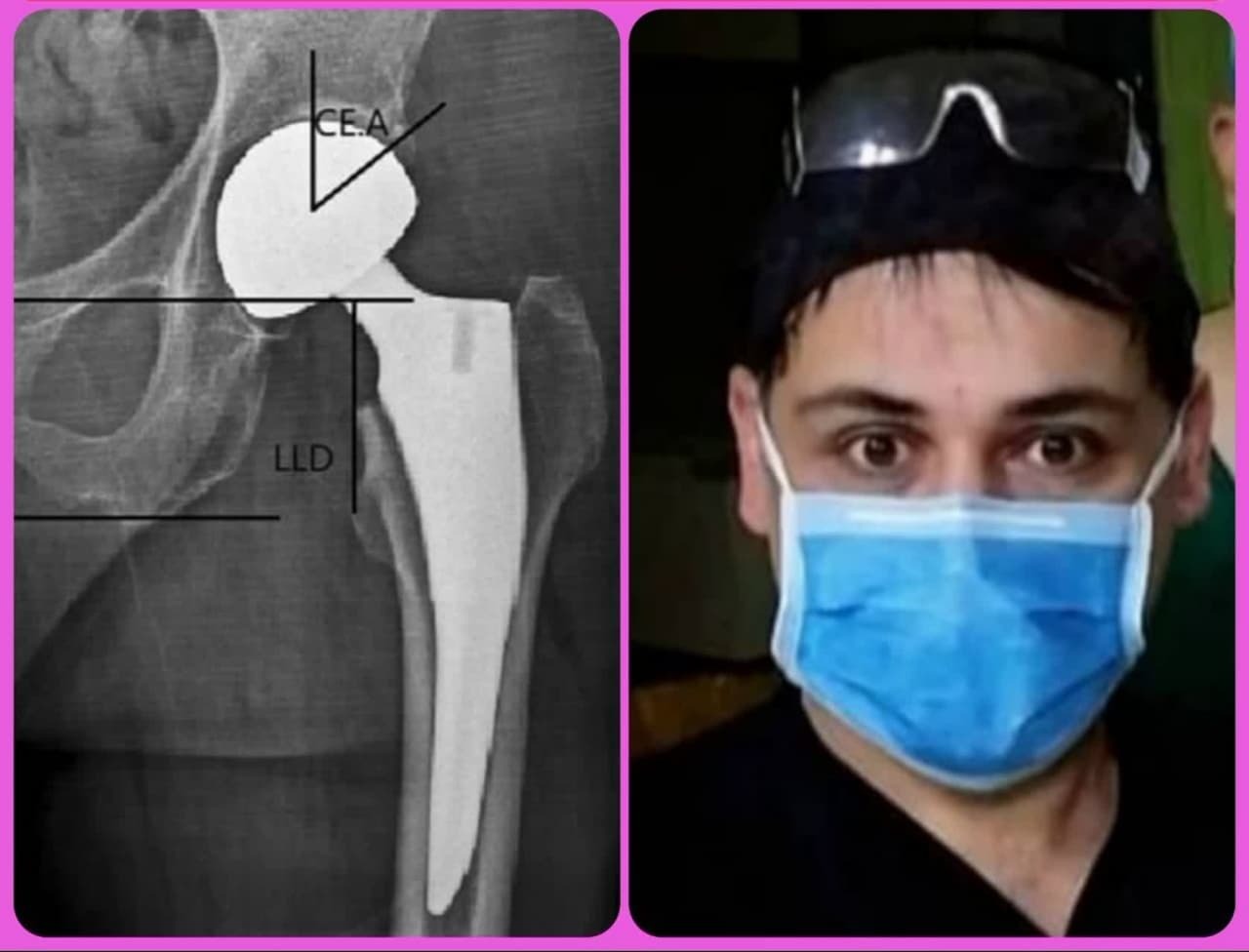 اولین عمل جراحی تعویض مفصل لگن در بیمارستان مهر امام علی (ع) تکاب