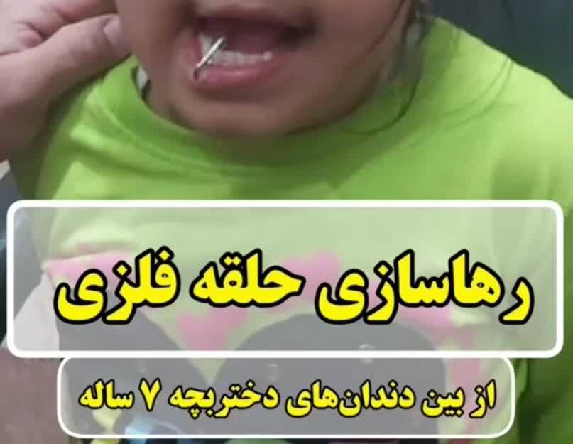 رهاسازی حلقه فلزی از میان دندان‌های دختر بچه ۷ ساله دزفولی