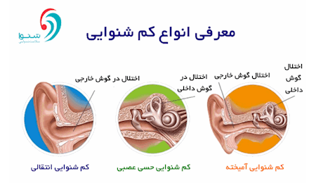 انواع کاهش شنوایی در کودکان