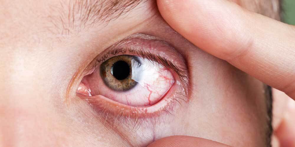 درمان بیماری خشکی چشم با کمک پروبیوتیک