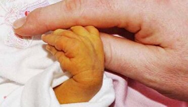 زردی بیماری شایع، اما قابل کنترل و درمان در نوزادان