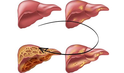 کبد چرب ، بیماری خاموش