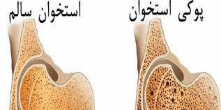 شیوع بیماری پوکی استخوان با افزایش جمعیت مسن