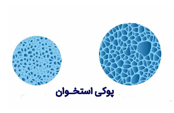 توصیه‌هایی برای مراقبت از سالمندان در برابر خطر سقوط و شکستگی ناشی از پوکی استخوان