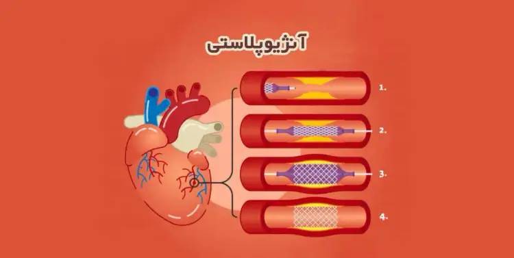 استفاده از جدیدترین روش‌های آنژیوپلاستی  در درمان بیماران مبتلا به تنگی عروق قلبی در مشهد