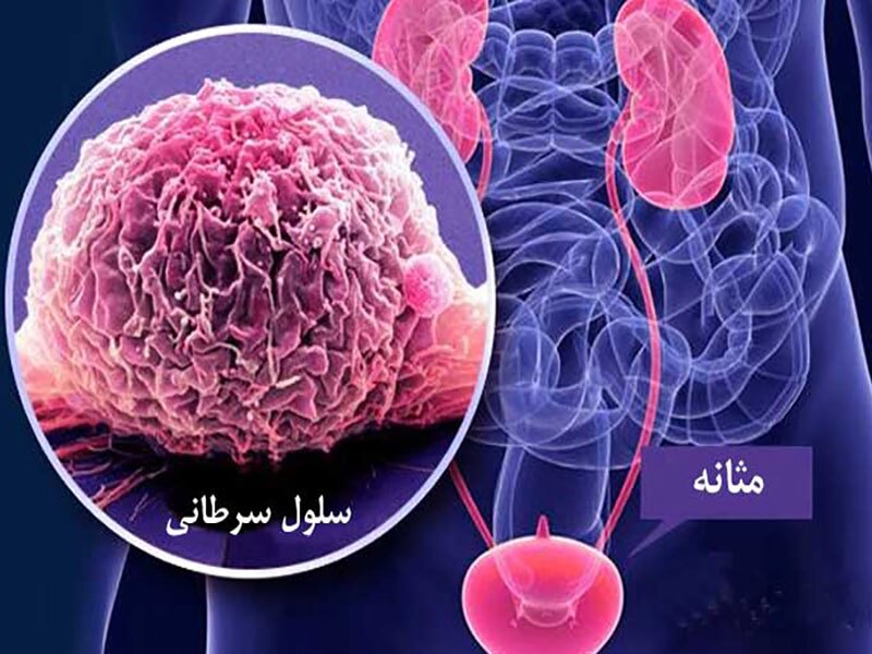 مراجعه به‌موقع؛ کلید موفقیت در درمان سرطان مثانه