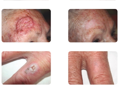درمان غیرتهاجمی سرطان پوست با ذرات رنیوم رادیواکتیو در بوشهر
