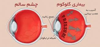 بیماری گلوکوم، یکی از شایع‌ترین بیماری‌های چشمی در کشور است