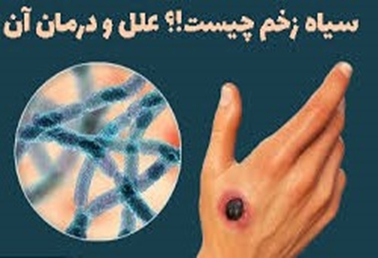 بیماری سیاه زخم (شاربن) را جدی بگیرید