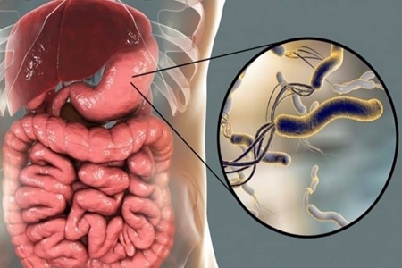 هلیکوباکتر پیلوری، عمده‌ترین علت عفونت و التهاب معده