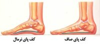 امکان درمان کف پای صاف در کودکان با حرکات اصلاحی