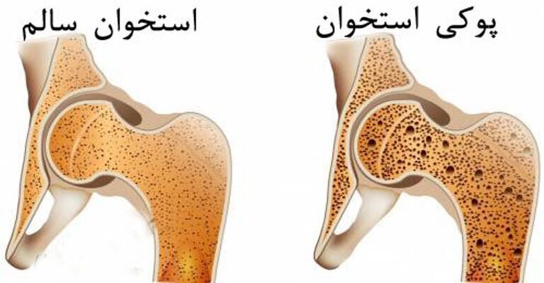 پوکی استخوان، بیماری خاموش