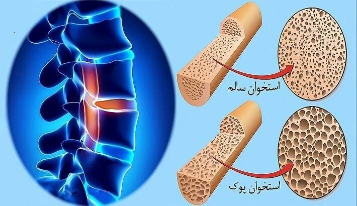 **پوکی استخوان، یک بیماری خاموش و مزمن