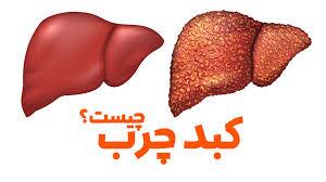 از بیماری کبد چرب بیشتر بدانید