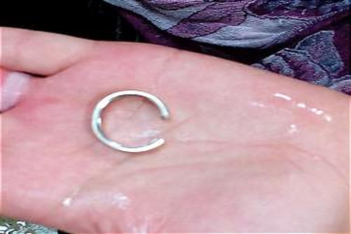 رهاسازی انگشتر دردسر ساز از دستان دختر ۵ ساله در شوش رهاسازی انگشتر دردسر ساز از دستان دختر ۵ ساله در شوش